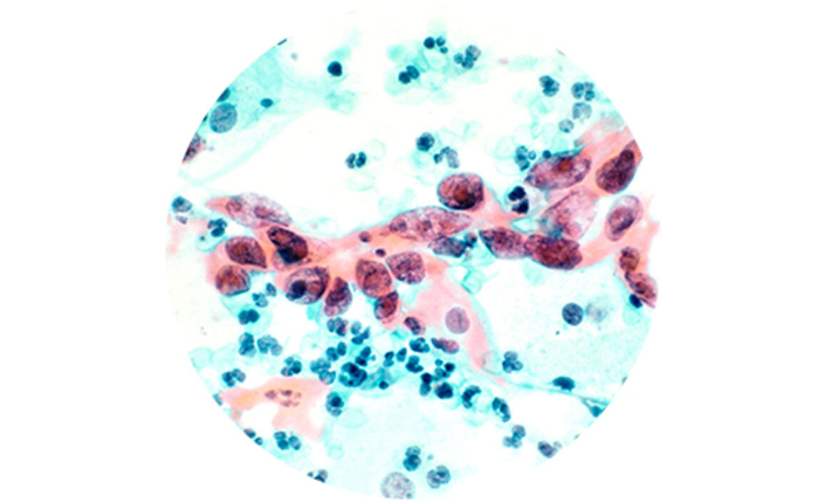 Humán papillómavírus (HPV) vizsgálat | Lab Tests Online-HU, Hpv vírus fáradtság